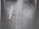 Lưỡi dao kẹt trong ngực gần năm trời mà không hay biết