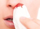 Đừng coi thường chảy máu mũi