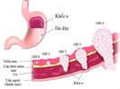 Các loại ung thư khó phát hiện sớm