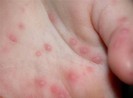 Bệnh tay chân miệng tăng 4 lần, Bộ Y tế ra công văn khẩn