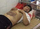Điều tra vụ bầm tím người sau khi làm việc với công an