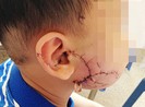 Trẻ ba tuổi bị chó berger cào cắn nát mặt