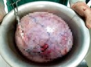 Bụng như mang thai 8 tháng, đi khám 'ra' khối u 5,5kg