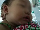 Kawasaki, bệnh lạ nguy hiểm