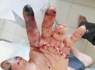 Khánh Hòa: Nối thành công bàn tay bị đứt lìa