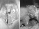 Cách phân biệt ung thư vòm họng và viêm họng