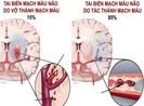 Tai biến mạch máu não: Cấp cứu thế nào để tránh tử vong?