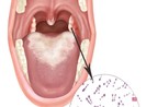 Đà Nẵng: Bệnh viện vất vả 'đi mượn' thuốc điều trị bạch hầu