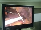 Người đàn ông bị tăm đâm thủng dạ dày, xuyên gan