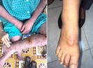 Coi chừng nhầm lẫn bệnh phong với viêm da