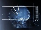 Ba cây đinh cắm vào sọ vẫn sống sót