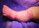 Bố mẹ đắp lá chữa bỏng nước sôi khiến bé 9 tháng tử vong