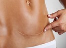 Bất ngờ vì thai làm tổ ở vết sẹo mổ cũ