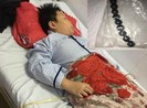 Bé trai 10 tuổi hoại tử ruột vì nuốt 9 viên bi nam châm