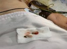 Cảnh báo liên tiếp người lớn tuổi ăn uống bị hít sặc tử vong