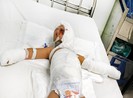 Bé trai bị bỏng nặng sau vụ ném bom xăng trả thù của người lớn