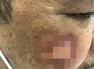 Tưởng bệnh về da, hóa ra bệnh tâm thần