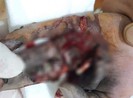 Điện thoại đang sạc phát nổ làm nát bàn tay thiếu niên