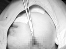 Hóc xương cá lóc 5 ngày, cổ họng bé gái đầy ổ áp xe