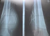 70 cây đinh tự trồi ra khỏi chân 1 phụ nữ