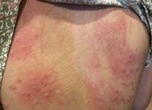 Đà Nẵng: Lấy mẫu nước, truy nguyên nhân gây ngứa sau tắm biển