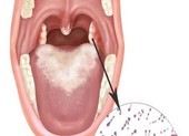 5 khuyến cáo của Bộ Y tế phòng chống bệnh bạch hầu