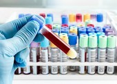 COVID-19: Người nhóm máu nào dễ nhiễm bệnh nhất?