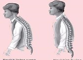 Tại sao dùng canxi đắt tiền vẫn bị loãng xương?