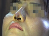 Lâm Đồng: Trụ mũi đứt lìa do 'bác sĩ thẩm mỹ' rởm 