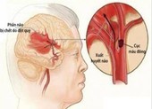 Phân loại các dạng đột quỵ