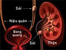 Sỏi thận hình thành trong cơ thể bạn như thế nào