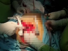 Cứu sống nam bệnh nhân nghi bị người yêu đâm trọng thương