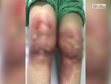 Video: Rước họa khi tự đắp lá chữa đau khớp gối