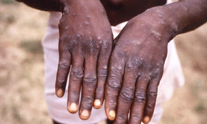 Các tổn thương trên da do đậu mùa khỉ gây ra. Ảnh: AFP