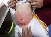 Mẹ dùng dầu gió bất cẩn, bé 14 tháng tuổi bị bỏng