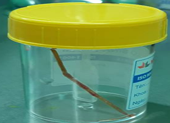 Hoãn mổ tim vì tăm tre 6 cm đâm thủng ruột