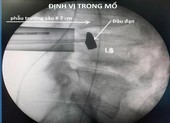 Lấy thành công đầu đạn 51 năm nằm trong cơ thể