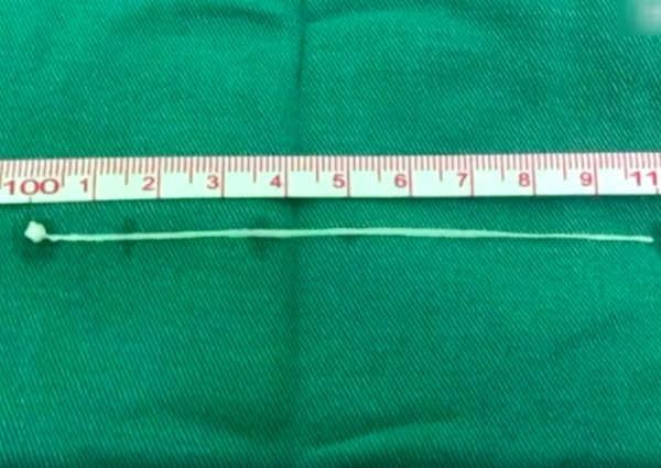 Kinh dị giun dài 10 cm sống trong não người đàn ông 30 năm
