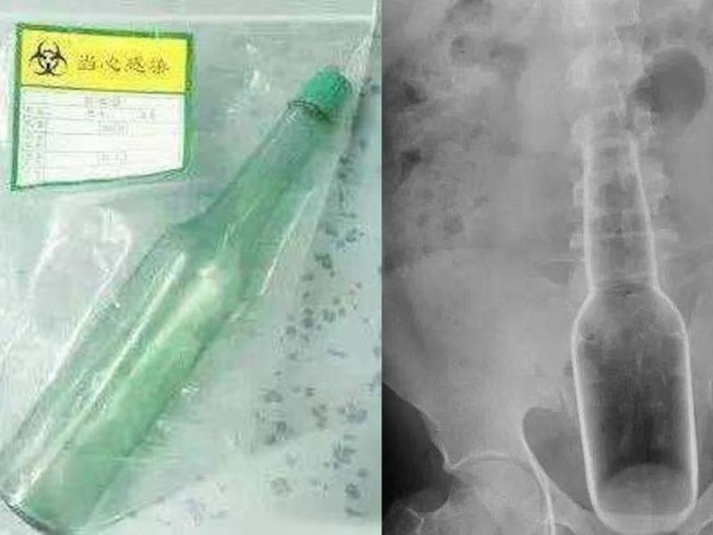 Gãi ngứa, người đàn ông để kẹt cái chai vào mông