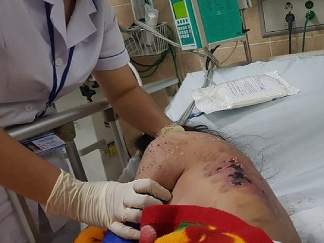 Không chịu kích dục chiều khách, cô gái trẻ bị tra tấn dã man