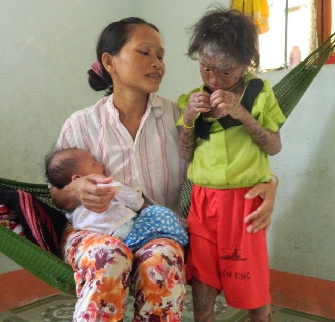 Bé 9 tuổi bị bệnh vảy cá hiếm gặp