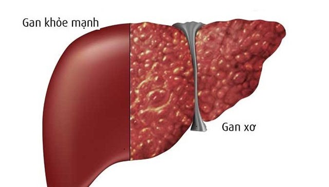 Hiểu đúng và đủ về bệnh xơ gan