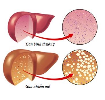 Gan nhiễm mỡ không 'nể' ai