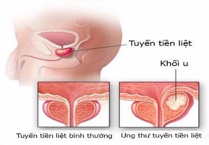 10 căn bệnh ung thư có nguy cơ cao với nam giới