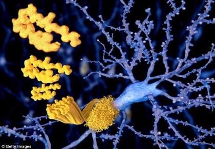 Giảm cân quá mức dễ bị mất trí nhớ