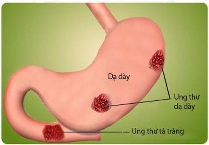 Nguyên nhân và cách phát hiện sớm ung thư dạ dày