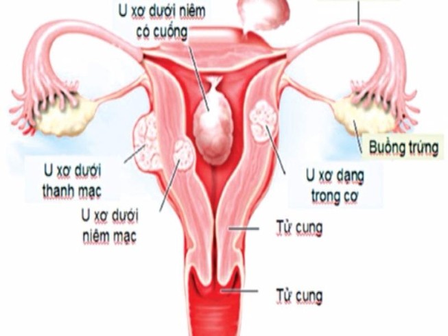Nhân xơ tử cung khi nào thì phẫu thuật?