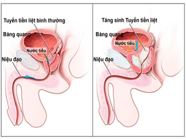 Nguyên nhân và cách phòng tránh phì đại tiền liệt tuyến