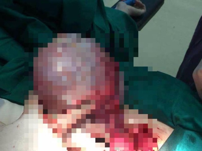 Tưởng béo bụng, hóa ra mang trong mình khối u khủng