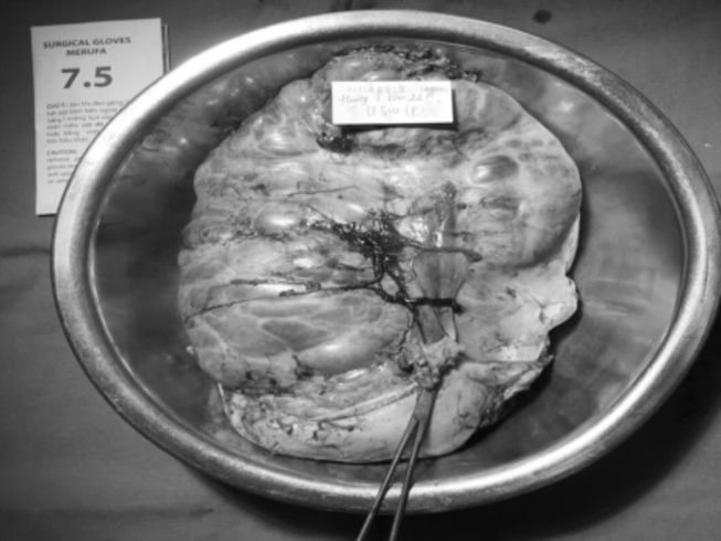 Thiếu nữ suy kiệt vì phải 'đeo' khối u buồng trứng 16kg